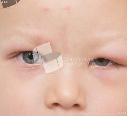 Image of allergy after mosquitoes