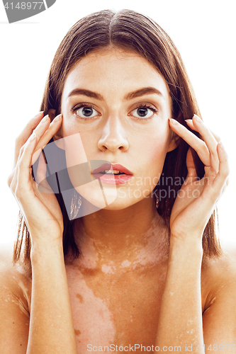 Image of beautiful young brunette woman with vitiligo disease close up isolated on white positive smiling, model problems concept, bad tan problem