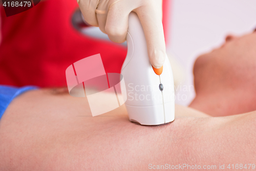 Image of male laser epilation