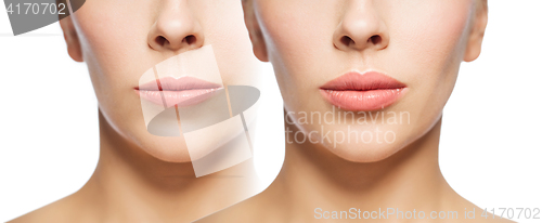 Image of woman before and after lip fillers