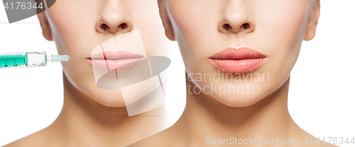 Image of woman before and after lip fillers injection