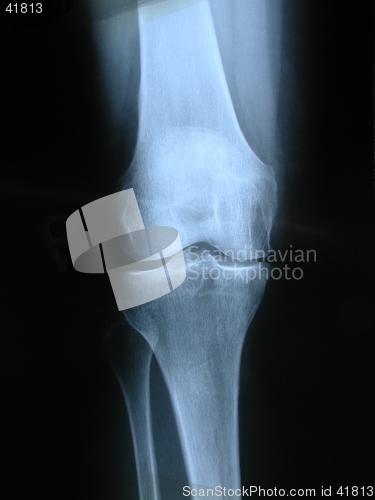 Image of X-ray