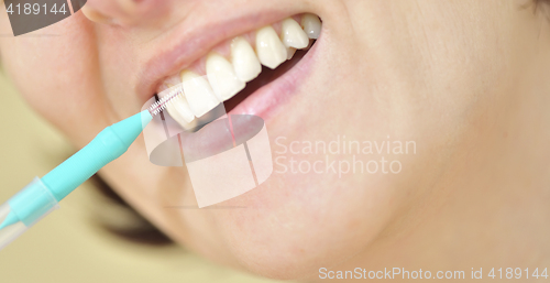 Image of Teeth with an interdental brush