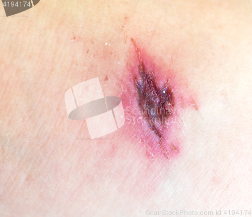 Image of wound 