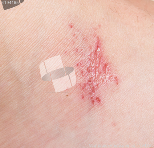 Image of wound on skin