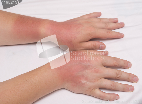 Image of sunburn