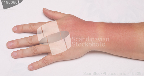 Image of sunburn