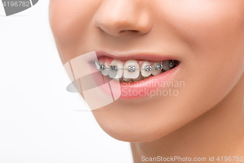 Image of Beautiful young woman with teeth braces