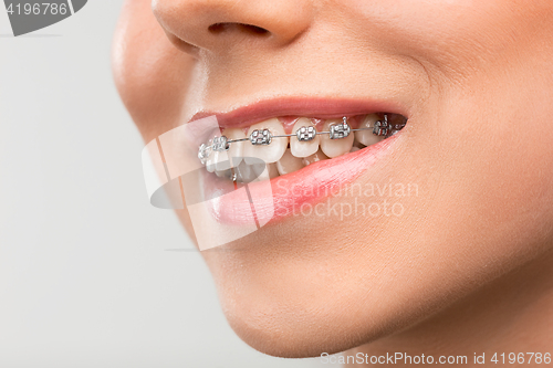 Image of Beautiful young woman with teeth braces