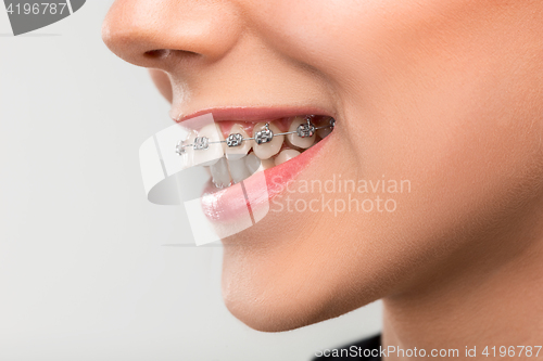 Image of Beautiful young woman with teeth braces