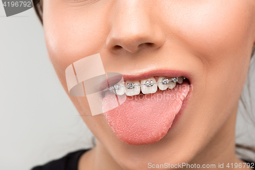 Image of Beautiful young woman with teeth braces