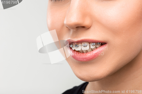 Image of Beautiful young woman with teeth braces