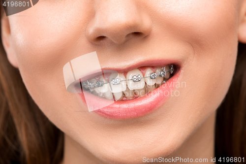 Image of Beautiful young woman with teeth braces