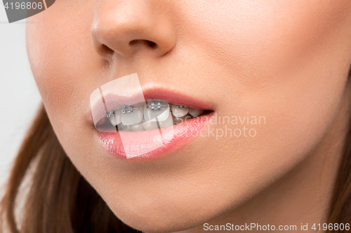 Image of Beautiful young woman with teeth braces