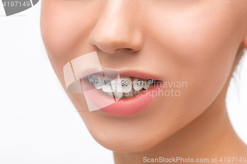 Image of Beautiful young woman with teeth braces