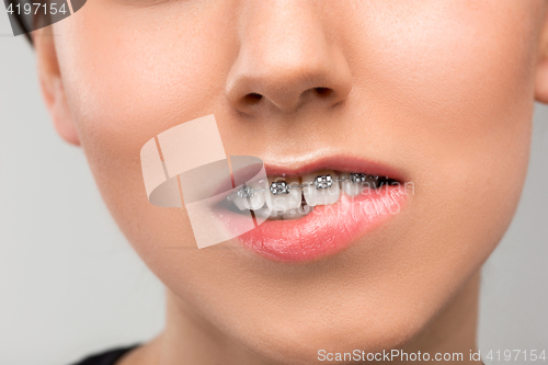 Image of Beautiful young woman with teeth braces