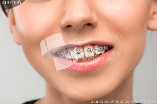 Image of Beautiful young woman with teeth braces