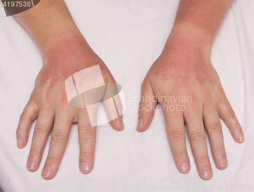 Image of sunburn