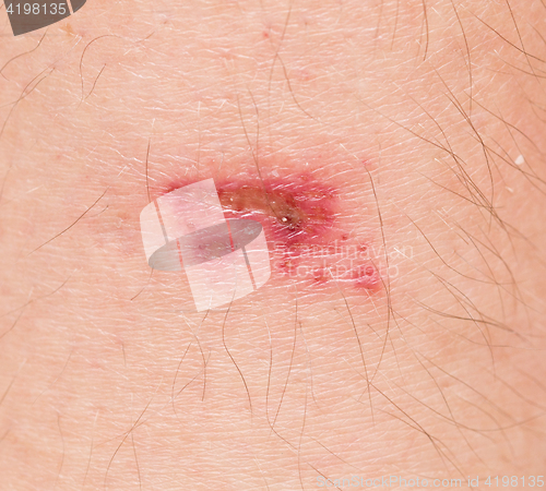 Image of wound on skin