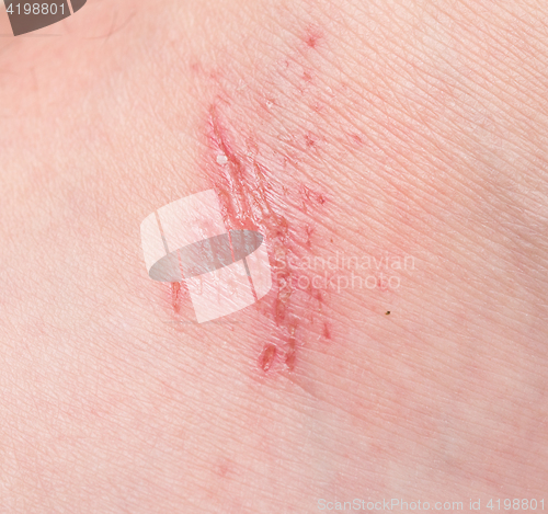 Image of wound on skin