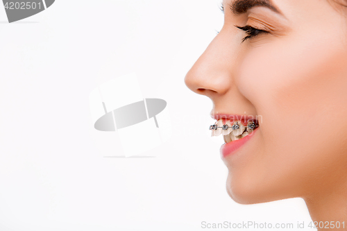 Image of Beautiful young woman with teeth braces