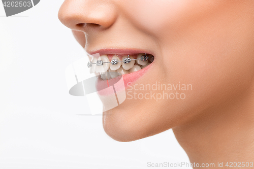 Image of Beautiful young woman with teeth braces