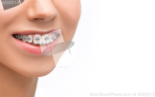 Image of Beautiful young woman with teeth braces