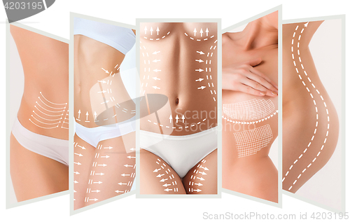 Image of The cellulite removal plan. White markings on young woman body