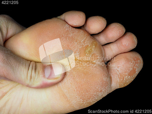 Image of Skin peeling off from under foot, at closeup towards black