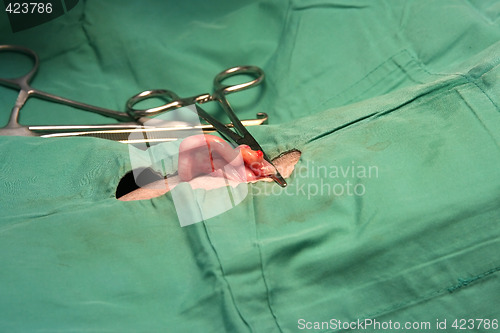 Image of Clipping off the intestine