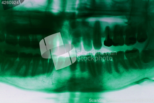 Image of teeth xray picture
