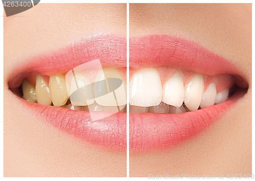 Image of The female teeth before and after whitening.