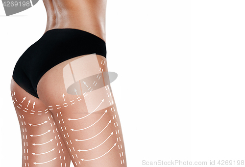 Image of Marks on the women\'s buttocks, waist and legs before plastic surgery.