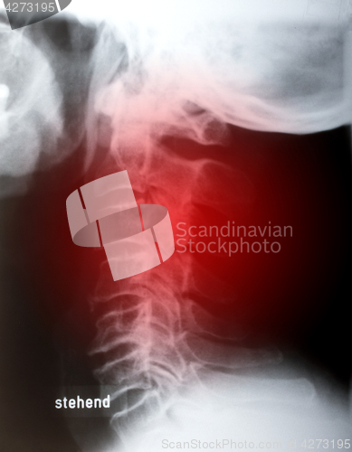 Image of Human neck sidelong 