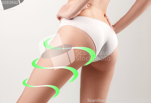 Image of Marks on the women\'s buttocks, waist and legs before plastic surgery.