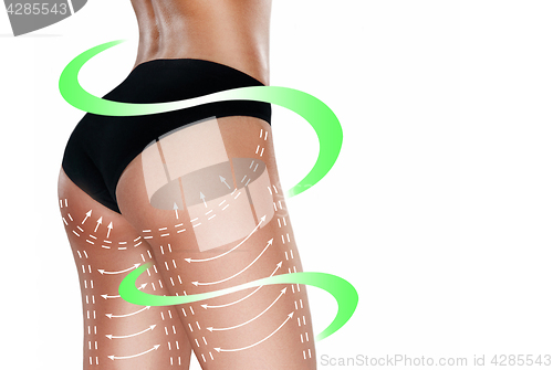 Image of Marks on the women\'s buttocks, waist and legs before plastic surgery.