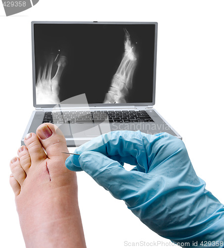 Image of Foot surgery