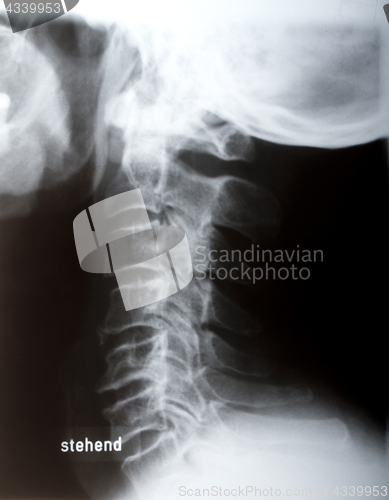 Image of Human neck sidelong 