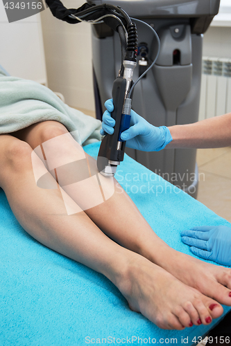 Image of laser legs epilation