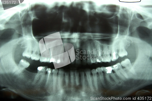 Image of roentgen – jaw, mandible