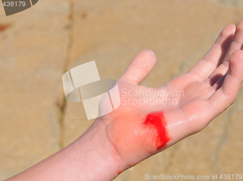 Image of Wounded hand