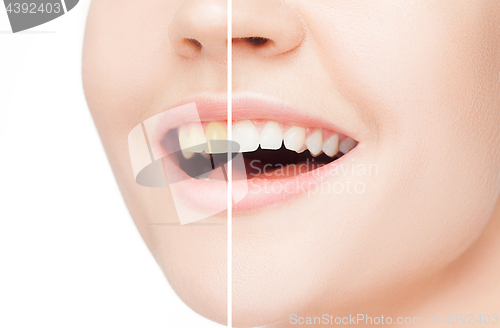 Image of The female teeth before and after whitening.