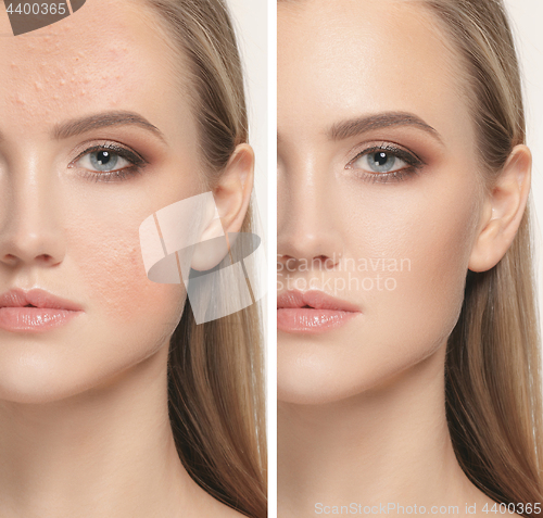 Image of Woman before and after treatment