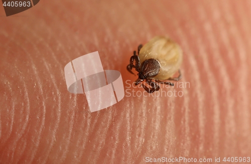 Image of Tick on skin