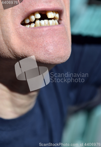 Image of mouth missing front tooth awaiting implant in senior male citize