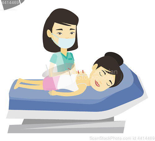 Image of Acupuncturist doctor making acupuncture therapy.