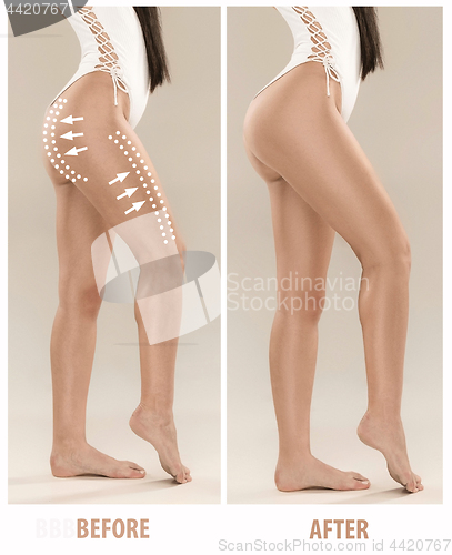 Image of Woman\'s buttocks before and after plastic surgery
