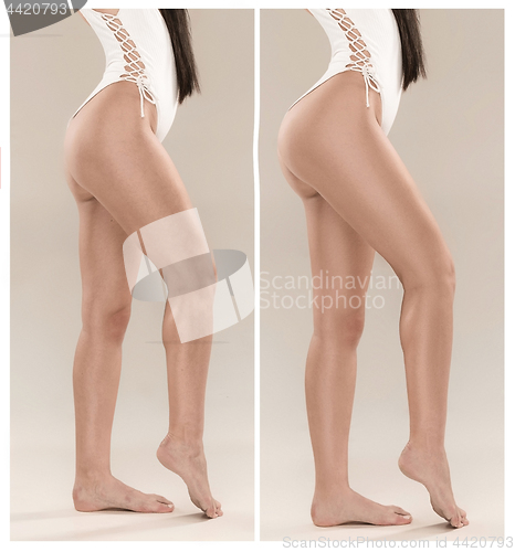 Image of Woman\'s buttocks before and after plastic surgery