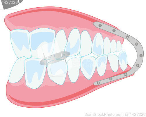 Image of Denture on white background is insulated