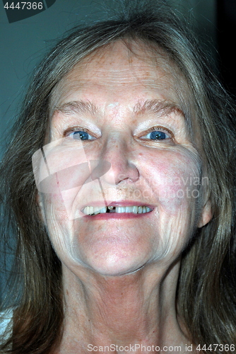 Image of Female with missing tooth cap.